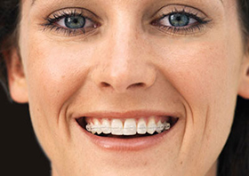Clear Braces - Anderson & Moopen Orthodontics
