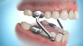 Orthopedic Appliances - Anderson & Moopen Orthodontics